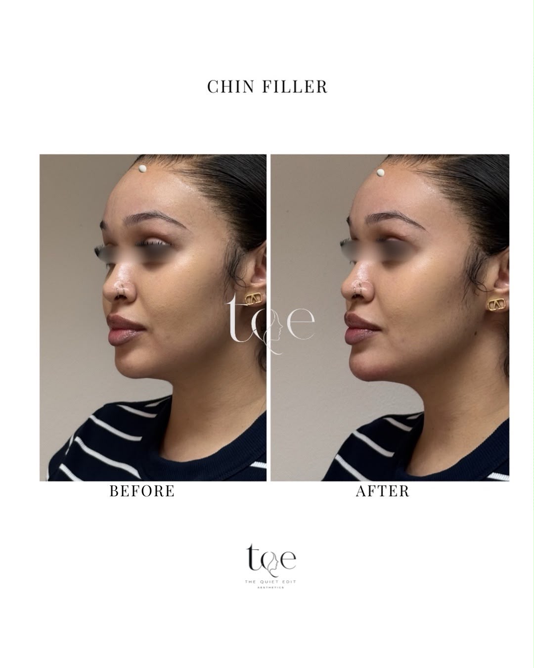 Chin Filler